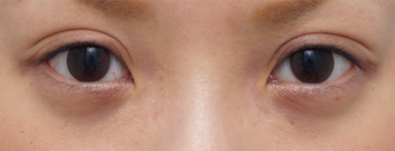 眼瞼下垂（がんけんかすい）,眼瞼下垂（がんけんかすい） デカ目に憧れていた若い女性の症例写真,After（メイクなし）,ba_ganken20_a01.jpg