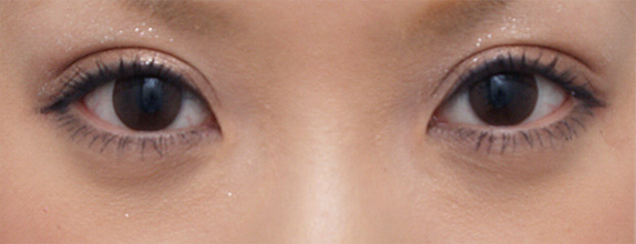 眼瞼下垂（がんけんかすい）,眼瞼下垂（がんけんかすい） デカ目に憧れていた若い女性の症例写真,After（メイクあり）<br/>
（1ヶ月後）,