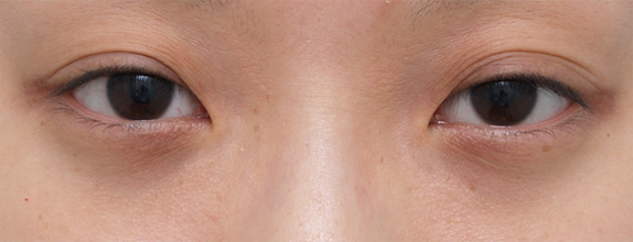 症例写真,眼瞼下垂（がんけんかすい） デカ目に憧れていた若い女性の症例写真,Before,ba_ganken20_b.jpg