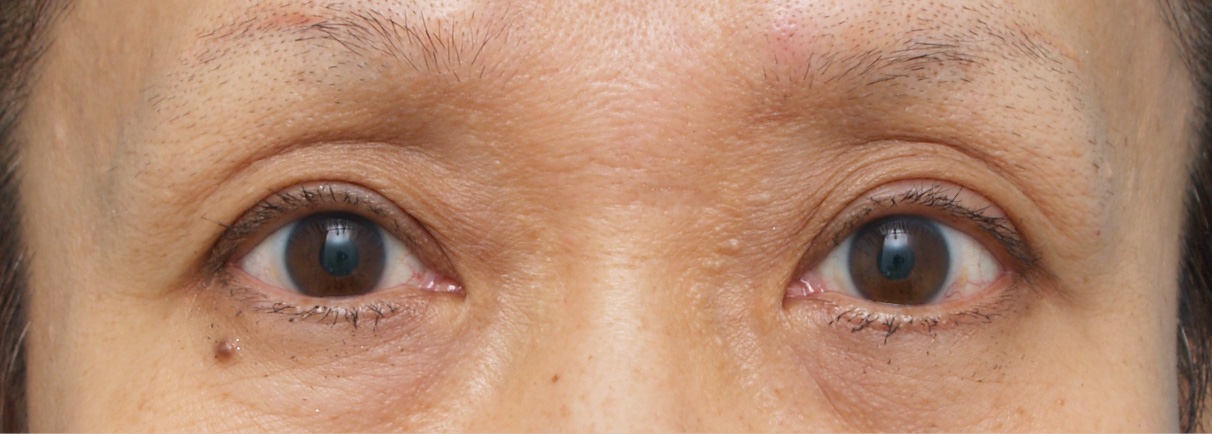 眼瞼下垂（がんけんかすい） 老人性眼瞼下垂で頭痛や肩こりに悩んでいた症例,After（メイクなし）,ba_ganken25_a01.jpg