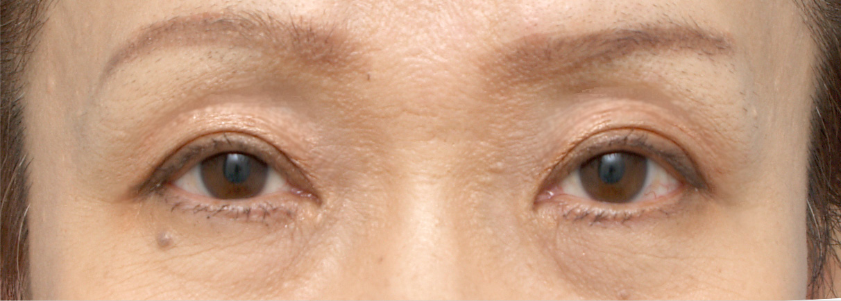 症例写真,眼瞼下垂（がんけんかすい） 老人性眼瞼下垂で頭痛や肩こりに悩んでいた症例,After（メイクあり）<br/>
（1ヶ月後）,