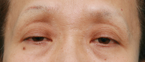 眼瞼下垂（がんけんかすい）,眼瞼下垂（がんけんかすい） 老人性眼瞼下垂で頭痛や肩こりに悩んでいた症例,施術前,mainpic_ganken03a.jpg