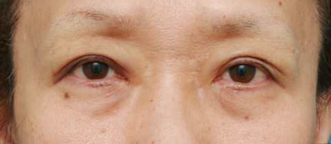 眼瞼下垂（がんけんかすい）,眼瞼下垂（がんけんかすい） 老人性眼瞼下垂で頭痛や肩こりに悩んでいた症例,施術直後,mainpic_ganken03b.jpg