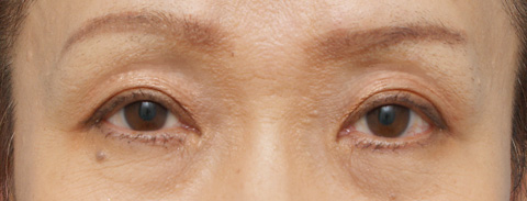 眼瞼下垂（がんけんかすい）,眼瞼下垂（がんけんかすい） 老人性眼瞼下垂で頭痛や肩こりに悩んでいた症例,1ヶ月後,メイクあり,mainpic_ganken03c.jpg