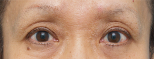 眼瞼下垂（がんけんかすい）,眼瞼下垂（がんけんかすい） 老人性眼瞼下垂で頭痛や肩こりに悩んでいた症例,1ヶ月後,メイクなし,mainpic_ganken03d.jpg