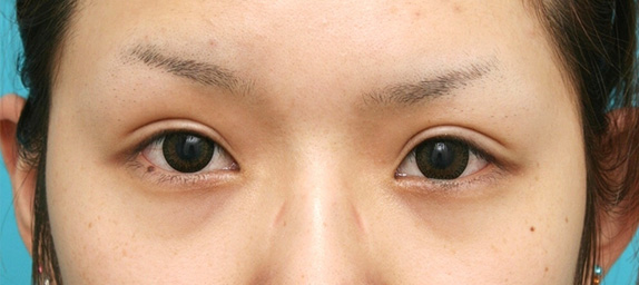 眼瞼下垂（がんけんかすい）,眼瞼下垂（がんけんかすい） 元々目を開ける力の弱い20代女性の症例,After（8ヶ月後）,ba_ganken30_a01.jpg
