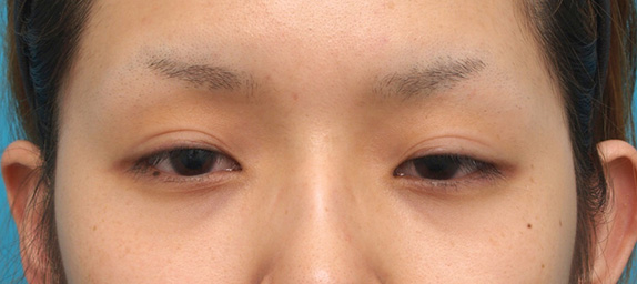 眼瞼下垂（がんけんかすい）,眼瞼下垂（がんけんかすい） 元々目を開ける力の弱い20代女性の症例,Before,ba_ganken30_b.jpg