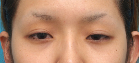 眼瞼下垂（がんけんかすい）,眼瞼下垂（がんけんかすい） 元々目を開ける力の弱い20代女性の症例,施術前,mainpic_ganken04a.jpg
