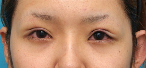 眼瞼下垂（がんけんかすい）,眼瞼下垂（がんけんかすい） 元々目を開ける力の弱い20代女性の症例,施術直後,mainpic_ganken04b.jpg