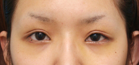 眼瞼下垂（がんけんかすい）,眼瞼下垂（がんけんかすい） 元々目を開ける力の弱い20代女性の症例,1週間後,mainpic_ganken04c.jpg