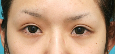 眼瞼下垂（がんけんかすい）,眼瞼下垂（がんけんかすい） 元々目を開ける力の弱い20代女性の症例,8ヶ月後,mainpic_ganken04d.jpg