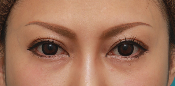 目の下の脂肪取り,二重まぶた全切開法+目尻切開+タレ目形成（グラマラスライン）+目の下脂肪取りで目の印象を変えた症例写真の術前術後画像,After（メイクあり）<br/>
（6ヶ月後）,