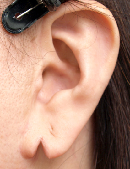 その他の耳の手術,傷跡　耳たぶのピアス裂傷を手術で修正した症例写真,Before,ba_mimiother04_b.jpg