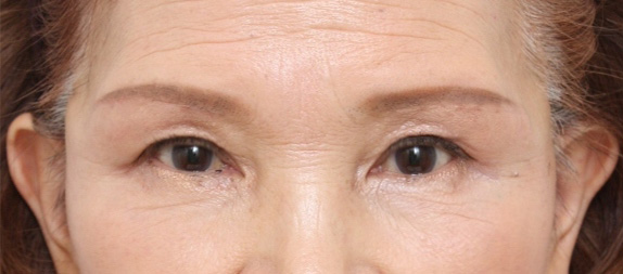 眉下リフト（上眼瞼リフト）,眉下での上まぶたたるみ取り（眉下リフト）の症例写真,After,ba_tarumi18_b.jpg
