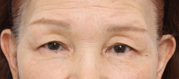 上まぶたたるみ取り,眉下リフト（上眼瞼リフト）,眉下での上まぶたたるみ取り（眉下リフト）の症例写真,Before,ba_tarumi18_b.jpg