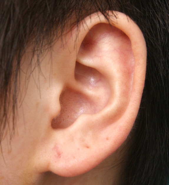 その他の耳の手術,ピアス穴を手術で修正した症例写真,After（1週間後）,ba_mimiother05_b.jpg