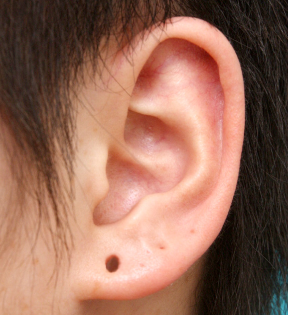 その他の耳の手術,ピアス穴を手術で修正した症例写真,Before,ba_mimiother05_b.jpg