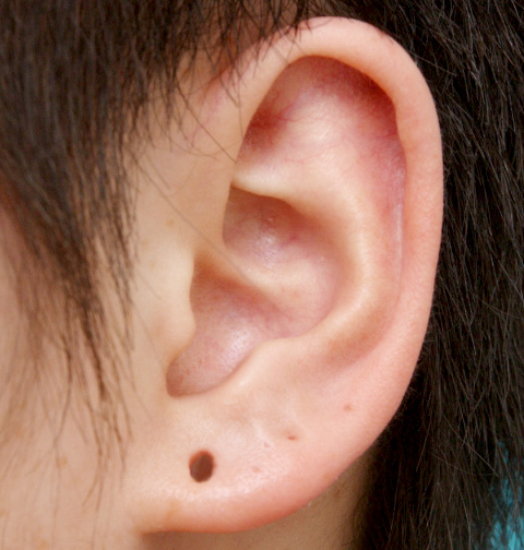 その他の耳の手術,ピアス穴を手術で修正した症例写真,手術前,mainpic_mimiother01a.jpg
