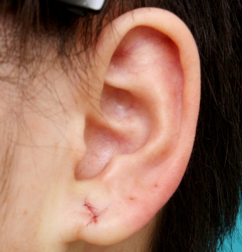 その他の耳の手術,ピアス穴を手術で修正した症例写真,手術直後,mainpic_mimiother01b.jpg