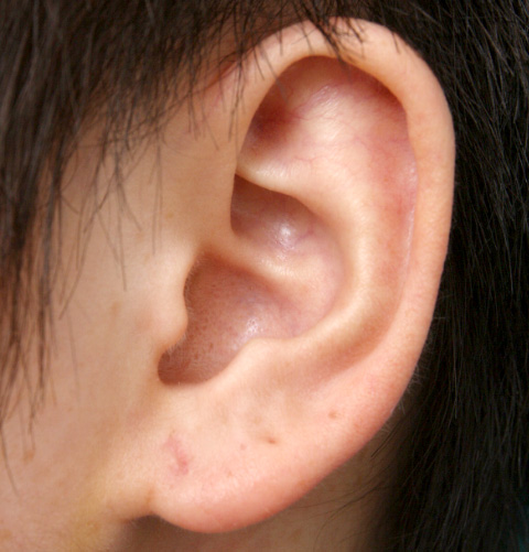その他の耳の手術,ピアス穴を手術で修正した症例写真,1週間後,mainpic_mimiother01c.jpg