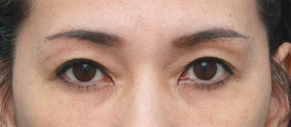 上まぶたたるみ取り,眉下リフト（上眼瞼リフト）,片目ずつ眉下リフト（上眼瞼リフト）した症例写真,After2週間空けて片側ずつ手術（メイクなし）,ba_tarumi20_a01.jpg