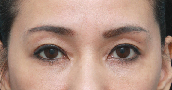 眉下リフト（上眼瞼リフト）,片目ずつ眉下リフト（上眼瞼リフト）した症例写真,After2週間空けて片側ずつ手術（メイクあり）,