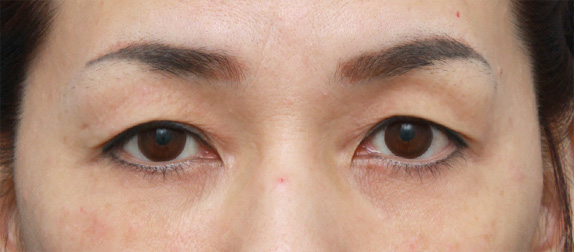 上まぶたたるみ取り,眉下リフト（上眼瞼リフト）,片目ずつ眉下リフト（上眼瞼リフト）した症例写真,Before手術前,ba_tarumi20_b.jpg