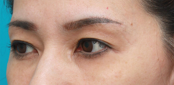 上まぶたたるみ取り,片目ずつ眉下リフト（上眼瞼リフト）した症例写真,After2週間空けて片側ずつ手術（メイクなし）,ba_tarumi21_b.jpg