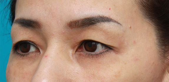 上まぶたたるみ取り,片目ずつ眉下リフト（上眼瞼リフト）した症例写真,Before,ba_tarumi21_b.jpg