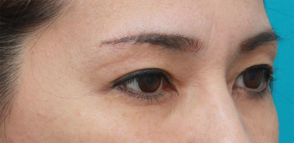 上まぶたたるみ取り,片目ずつ眉下リフト（上眼瞼リフト）した症例写真,After2週間空けて片側ずつ手術（メイクなし）,ba_tarumi22_b.jpg
