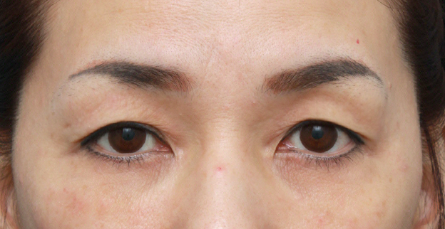 眉下リフト（上眼瞼リフト）,片目ずつ眉下リフト（上眼瞼リフト）した症例写真,手術前,mainpic_tarumi02a.jpg