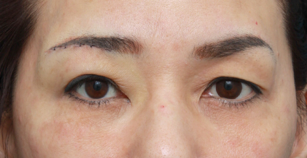 上まぶたたるみ取り,片目ずつ眉下リフト（上眼瞼リフト）した症例写真,右側手術直後,mainpic_tarumi02b.jpg