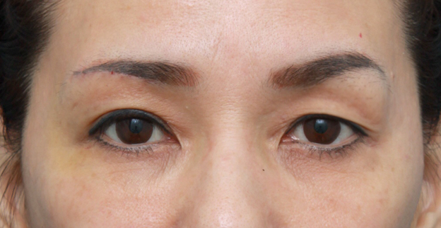 上まぶたたるみ取り,片目ずつ眉下リフト（上眼瞼リフト）した症例写真,右側術後1週間,mainpic_tarumi02c.jpg