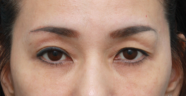 上まぶたたるみ取り,片目ずつ眉下リフト（上眼瞼リフト）した症例写真,右側術後2週間,mainpic_tarumi02d.jpg