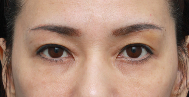 上まぶたたるみ取り,片目ずつ眉下リフト（上眼瞼リフト）した症例写真,左側術後2週間,mainpic_tarumi02f.jpg