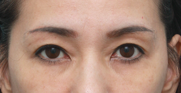 上まぶたたるみ取り,片目ずつ眉下リフト（上眼瞼リフト）した症例写真,左側術後1ヶ月,メイクなし,mainpic_tarumi02g.jpg