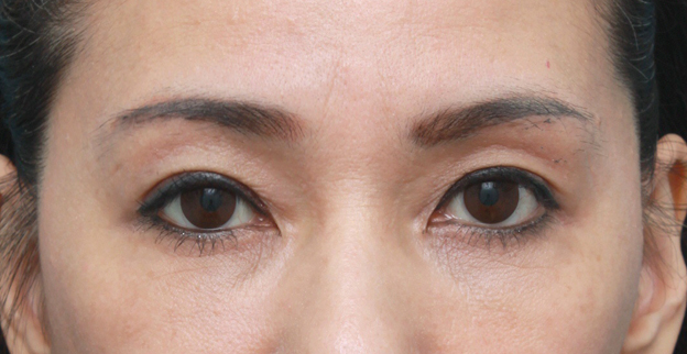 上まぶたたるみ取り,片目ずつ眉下リフト（上眼瞼リフト）した症例写真,左側術後1ヶ月,メイクあり,mainpic_tarumi02h.jpg