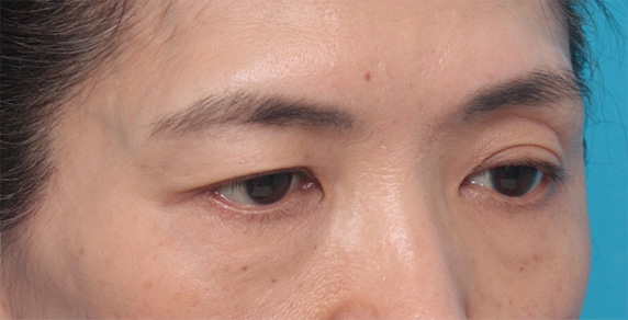 上まぶたたるみ取り,片目の上まぶたたるみ取り手術をして二重を作り、左右差を修正した症例写真,Before,ba_tarumi24_b.jpg