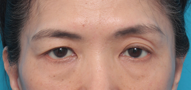 上まぶたたるみ取り,片目の上まぶたたるみ取り手術をして二重を作り、左右差を修正した症例写真,手術前,mainpic_tarumi03a.jpg