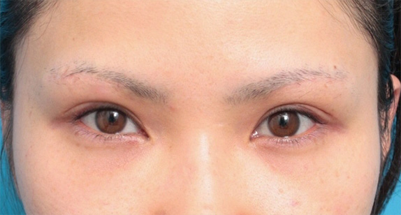 眉下リフト（上眼瞼リフト）,眉下リフト（上眼瞼リフト）で二重の幅を広げた20代女性の症例写真,After（メイクなし）,ba_jougankenlift01_b.jpg