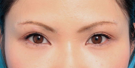 眉下リフト（上眼瞼リフト）,眉下リフト（上眼瞼リフト）で二重の幅を広げた20代女性の症例写真,After（メイクあり）<br/>
（6ヶ月後）,