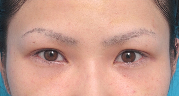上まぶたたるみ取り,眉下リフト（上眼瞼リフト）,眉下リフト（上眼瞼リフト）で二重の幅を広げた20代女性の症例写真,Before,ba_jougankenlift01_b.jpg