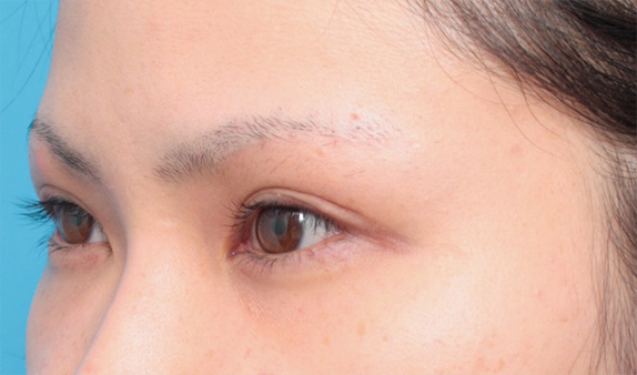 眉下リフト（上眼瞼リフト）,眉下リフト（上眼瞼リフト）で二重の幅を広げた20代女性の症例写真,After（メイクなし）,ba_jougankenlift02_b.jpg