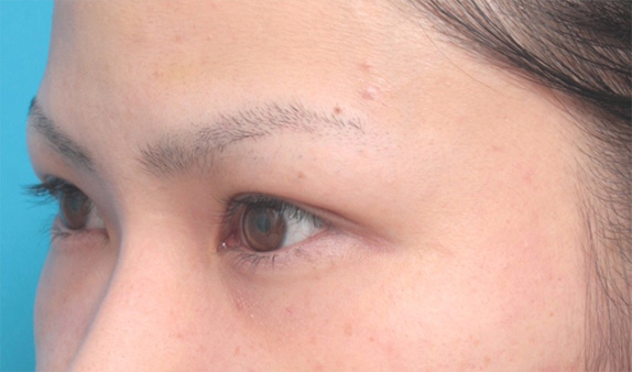 眉下リフト（上眼瞼リフト）,眉下リフト（上眼瞼リフト）で二重の幅を広げた20代女性の症例写真,Before,ba_jougankenlift02_b.jpg