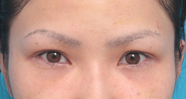 上まぶたたるみ取り,眉下リフト（上眼瞼リフト）で二重の幅を広げた20代女性の症例写真,手術前,mainpic_jougankenlift01a.jpg