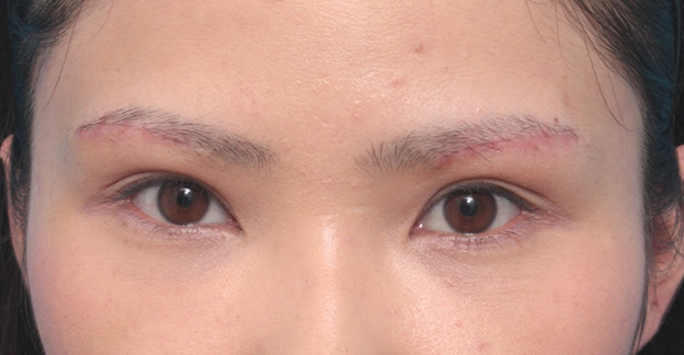 眉下リフト（上眼瞼リフト）,眉下リフト（上眼瞼リフト）で二重の幅を広げた20代女性の症例写真,1週間後,mainpic_jougankenlift01b.jpg