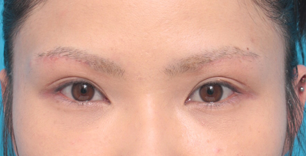 眉下リフト（上眼瞼リフト）,眉下リフト（上眼瞼リフト）で二重の幅を広げた20代女性の症例写真,2週間後,mainpic_jougankenlift01c.jpg