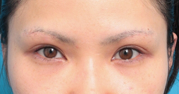 眉下リフト（上眼瞼リフト）,眉下リフト（上眼瞼リフト）で二重の幅を広げた20代女性の症例写真,6ヶ月後,メイクなし,mainpic_jougankenlift01d.jpg