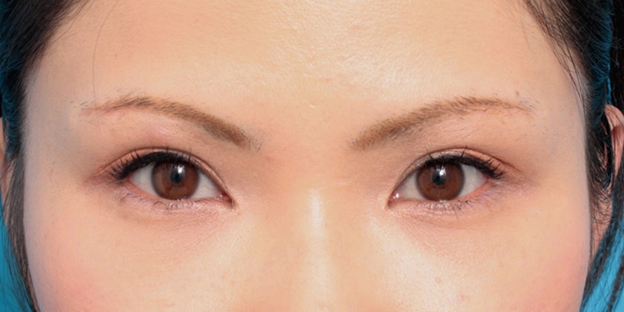 眉下リフト（上眼瞼リフト）,眉下リフト（上眼瞼リフト）で二重の幅を広げた20代女性の症例写真,6ヶ月後,メイクあり,mainpic_jougankenlift01e.jpg