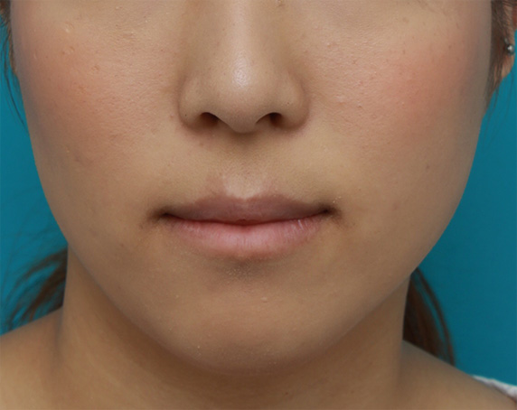 唇を薄く（口唇縮小術）,下唇のみを手術で薄くして、バランスを整えた症例写真,After,ba_usuku14_b.jpg